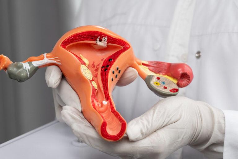 Endometriosis, Fibroid & Ovarian Care